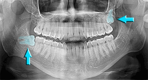 Wisdom Teeth Extraction