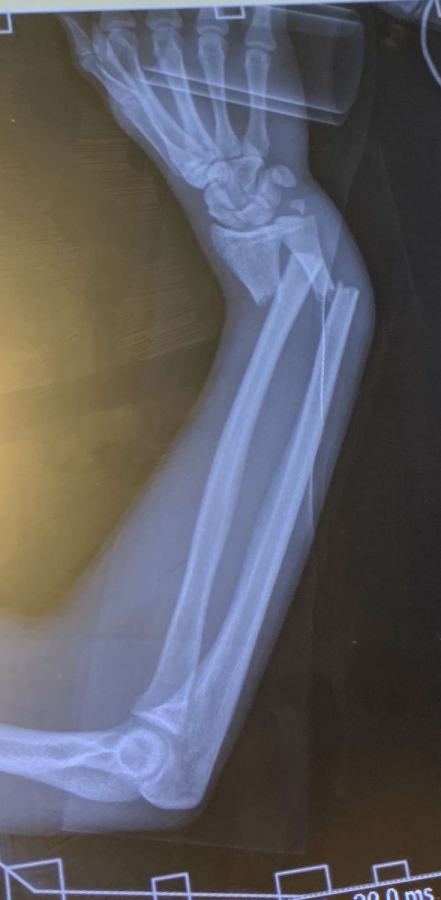 Senior Mason Tharp suffered this horrible wrist fracture during the 2019 football season.