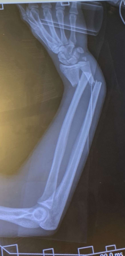 Senior+Mason+Tharp+suffered+this+horrible+wrist+fracture+during+the+2019+football+season.